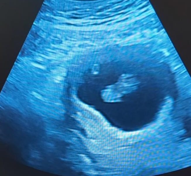 Hope and Resilience: My IVF Experience&nbsp;Explained